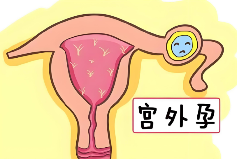 B超看不到孕囊，是否意味着宫外孕？